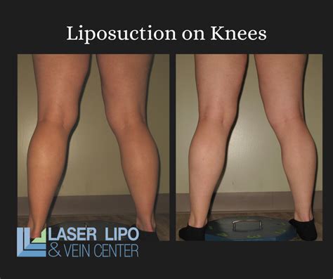 liposuction cost st louis|Cost Of Liposuction 